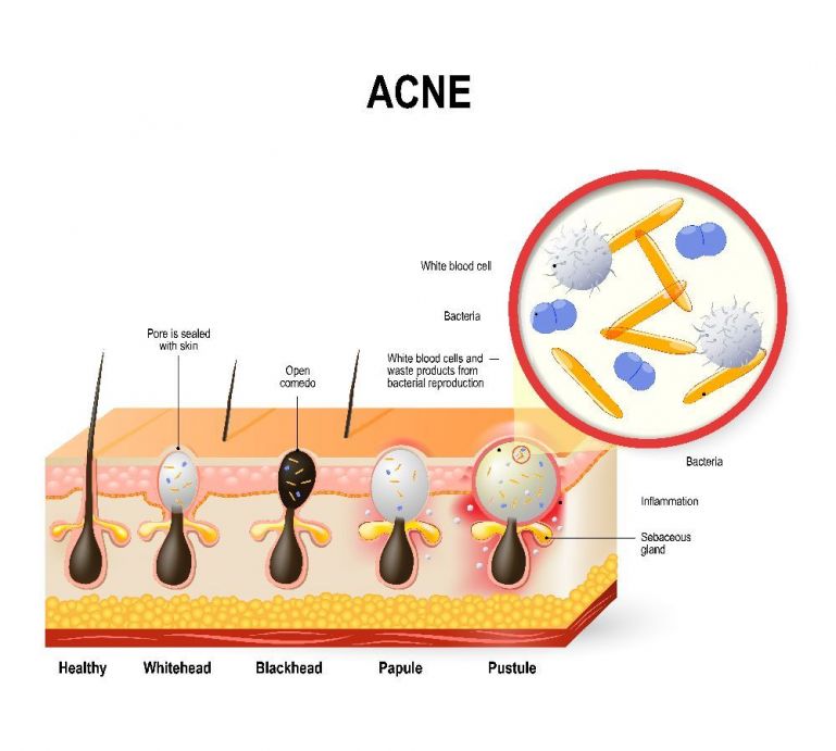 akne 3
