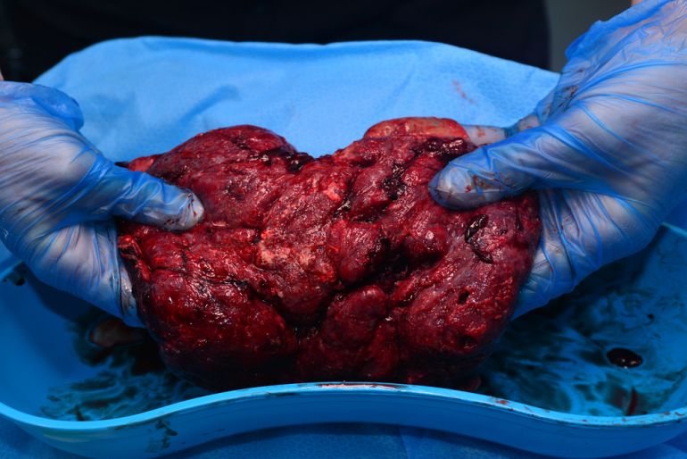 placenta shutterstock 200194118